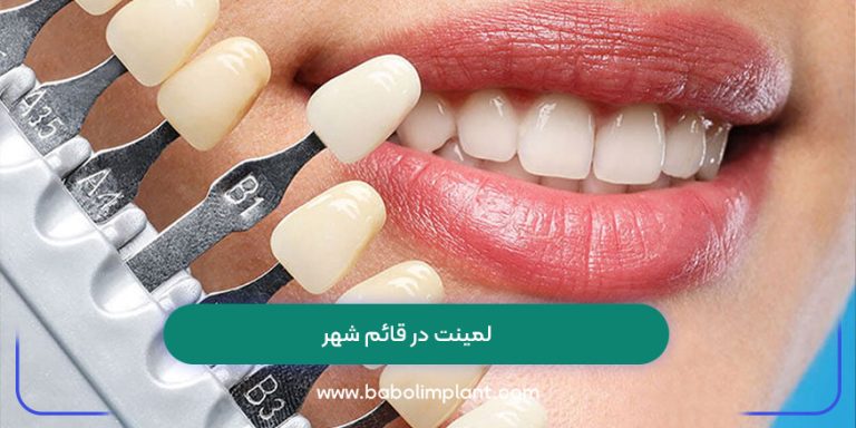 لمینت در قائم شهر