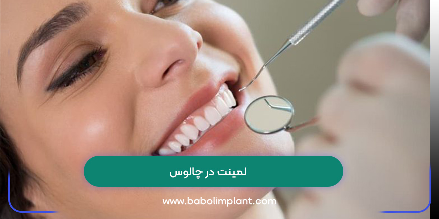 لمینت در چالوس