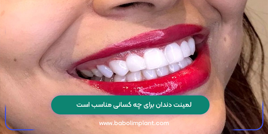 لمینت دندان برای چه کسانی مناسب است