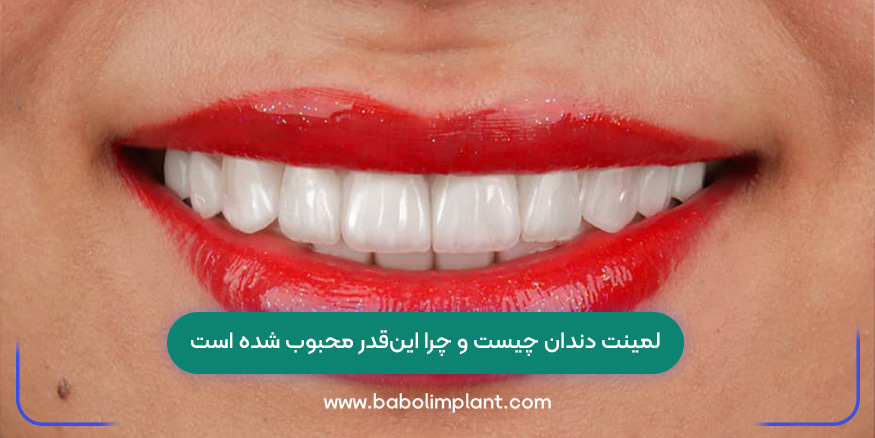 لمینت دندان چیست و چرا این‌قدر محبوب شده است