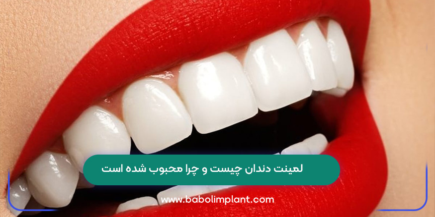لمینت دندان چیست و چرا محبوب شده است