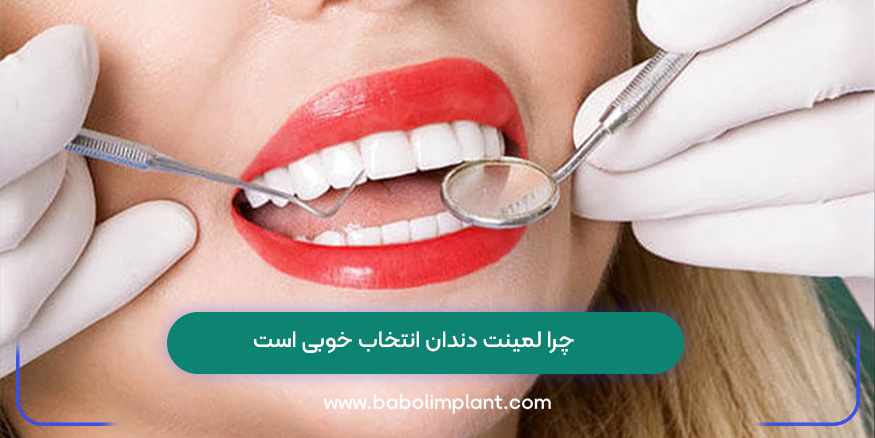 چرا لمینت دندان انتخاب خوبی است