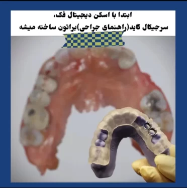 مرحله اول ایمپلنت