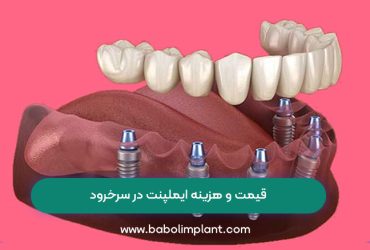 قیمت و هزینه ایملپنت در سرخرود