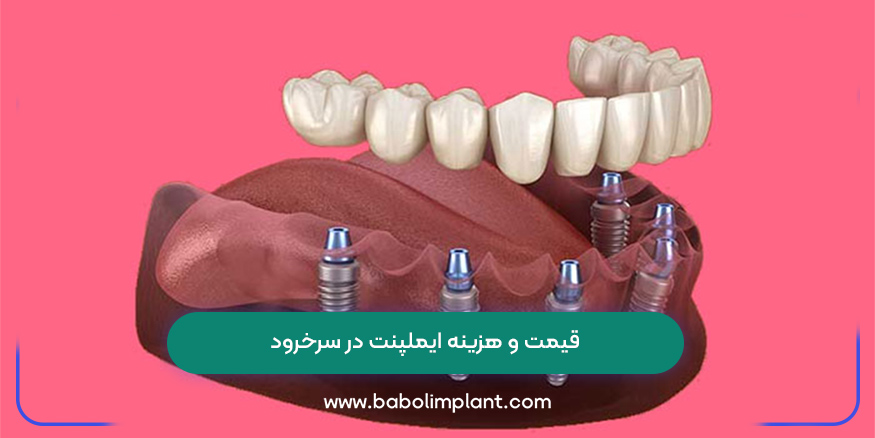 قیمت و هزینه ایملپنت در سرخرود