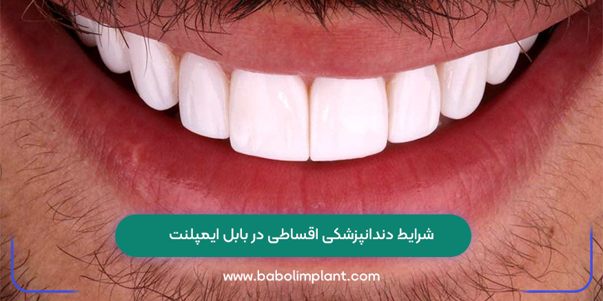 Installment dental conditions at Babol Implant