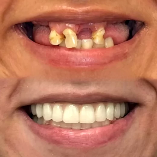 ایمپلنت دندان در بابل