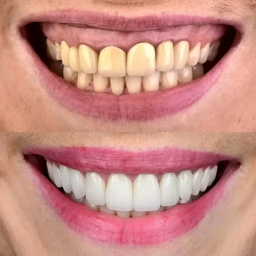 لمینت در بابل