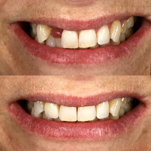 ایمپلنت در بابل