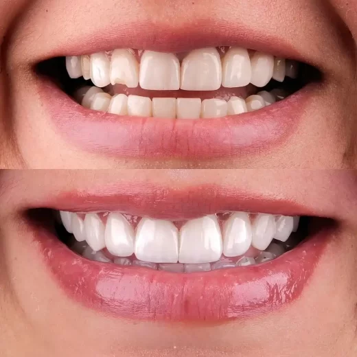 لمینت در بابل