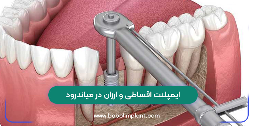 Cheap and installment implants in Meanderod