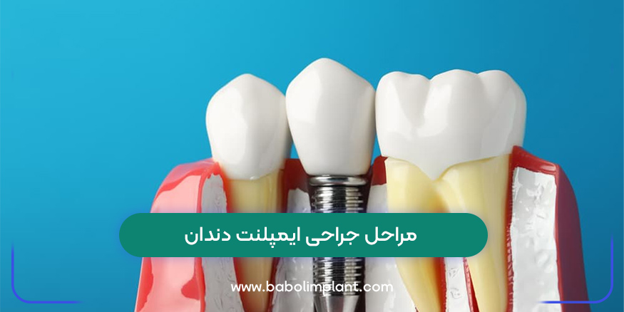 Dental implant surgery steps