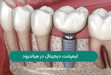 Digital implants in Meanderod