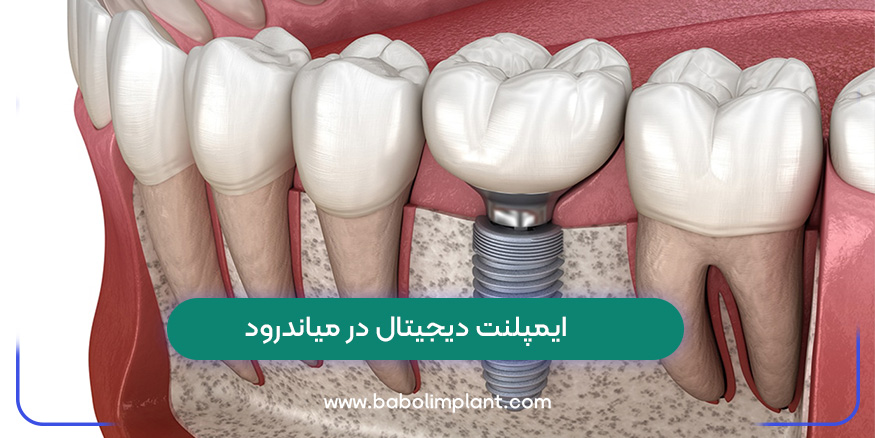 Digital implants in Meanderod