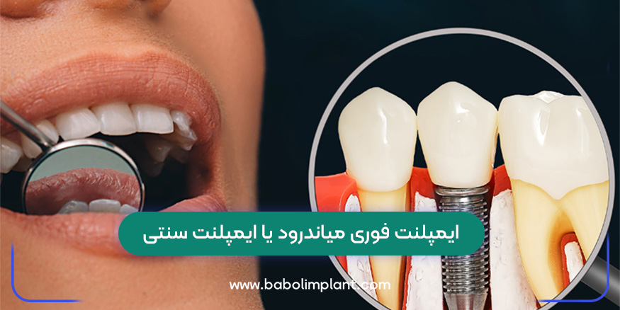 Immediate implant or traditional implant?