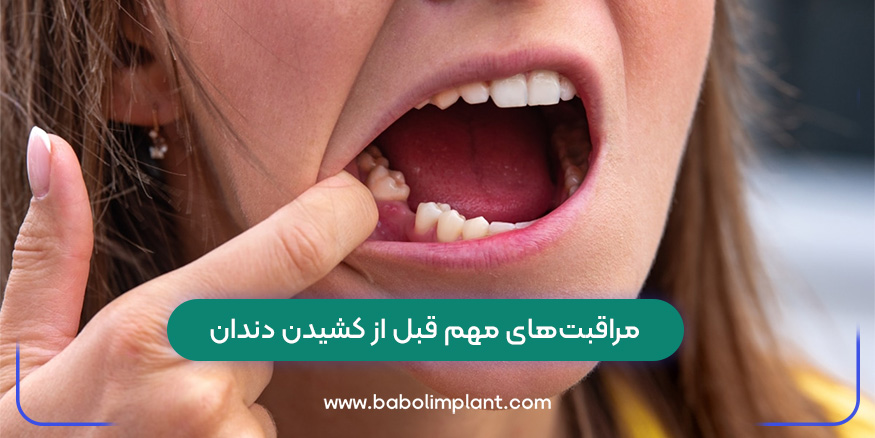 Important care before tooth extraction