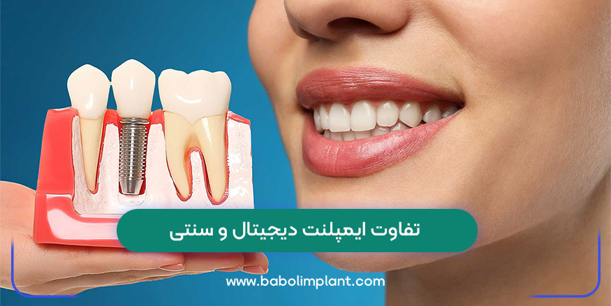 The difference between digital and traditional implants