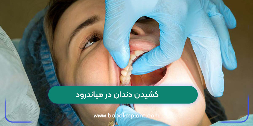 Tooth extraction in Meanderod