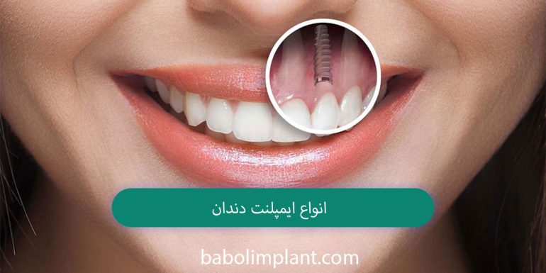 Types of dental implants
