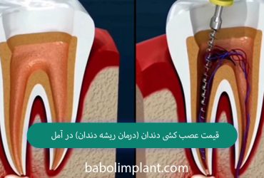 Price of root canal treatment in Amol