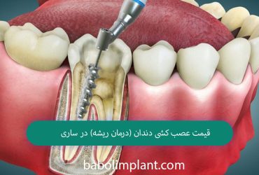 Price of tooth extraction (root canal treatment) in Sari