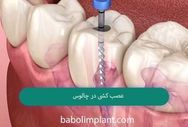 Nerve removal in Chalus