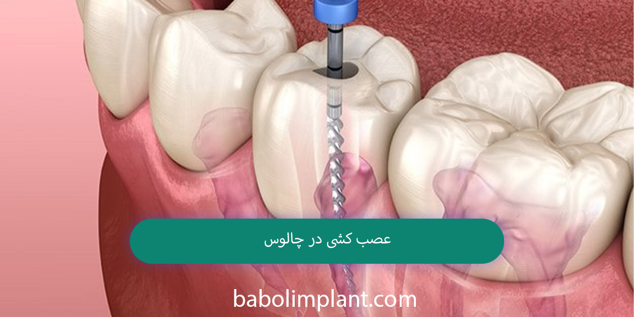 Nerve removal in Chalus