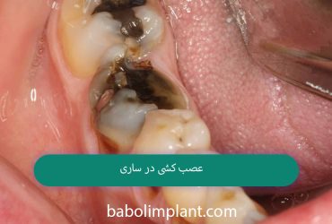 Nerve removal in Sari