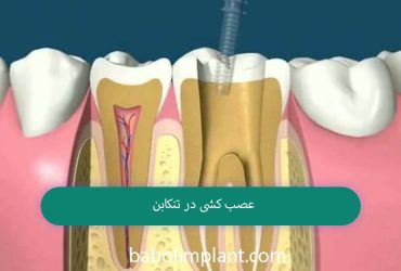 Nerve removal in Tonekabon