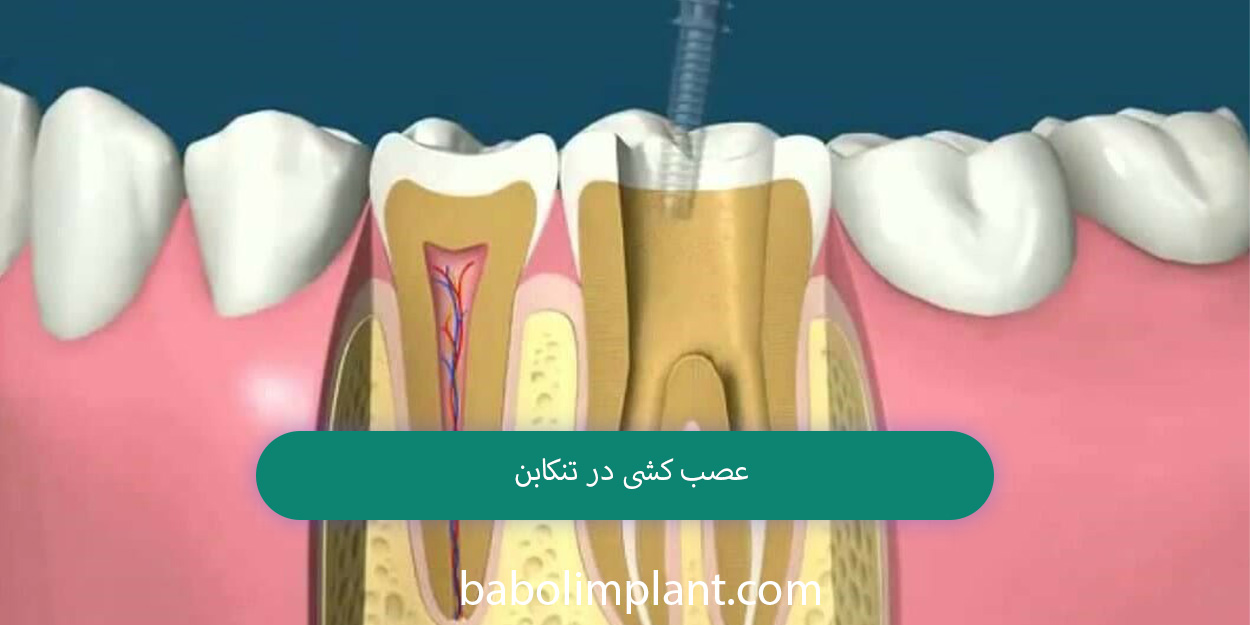 Nerve removal in Tonekabon