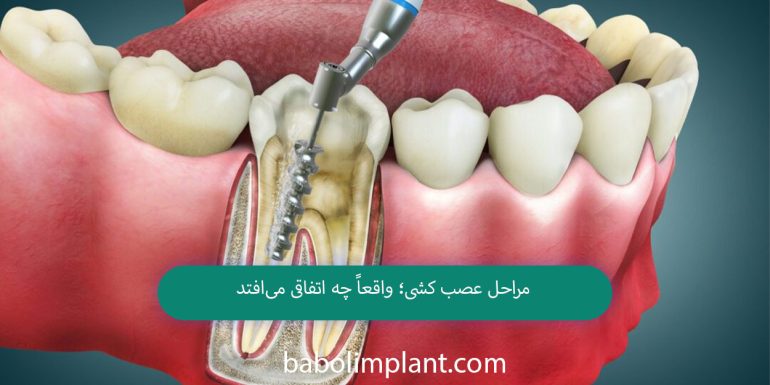 Stages of Nerve Removal: What Really Happens