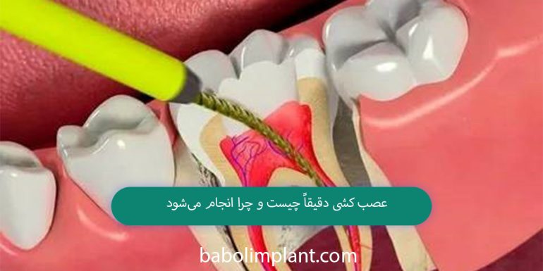 What exactly is nerve ablation and why is it done?