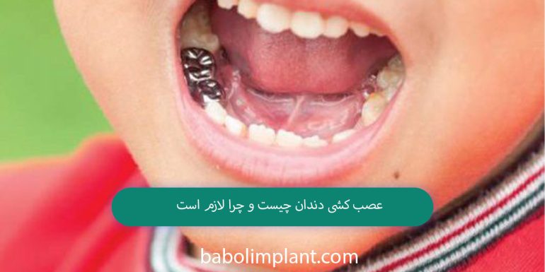 What is tooth extraction and why is it necessary?