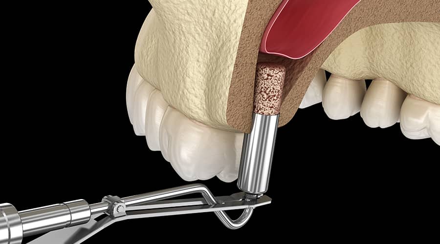 What is a sinus lift and what is its purpose?
