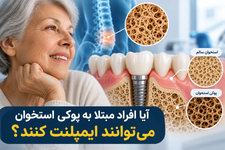 آیا افراد مبتلا به پوکی استخوان می‌توانند ایمپلنت کنند؟