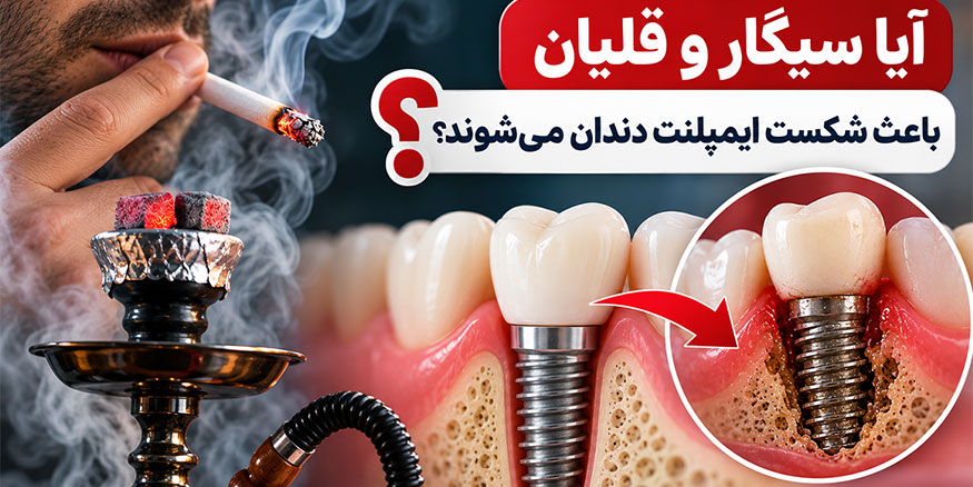 آیا سیگار و قلیان باعث شکست ایمپلنت دندان می‌شوند؟