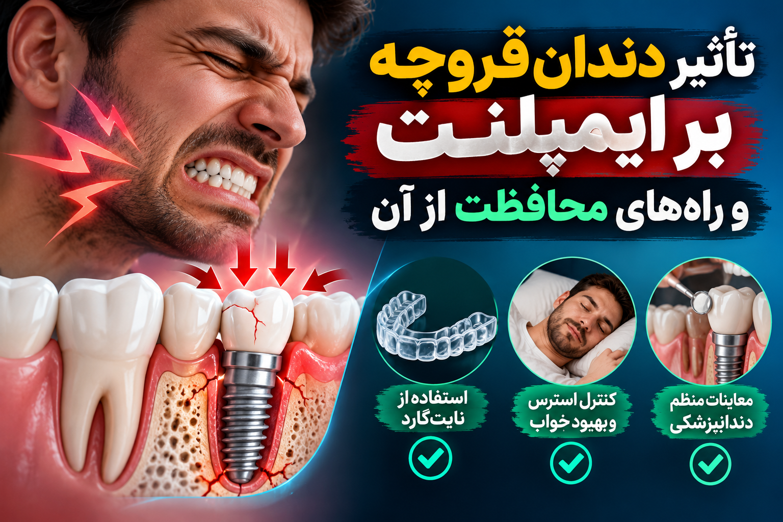 تأثیر دندان ‌قروچه بر ایمپلنت و راه‌های محافظت از آن