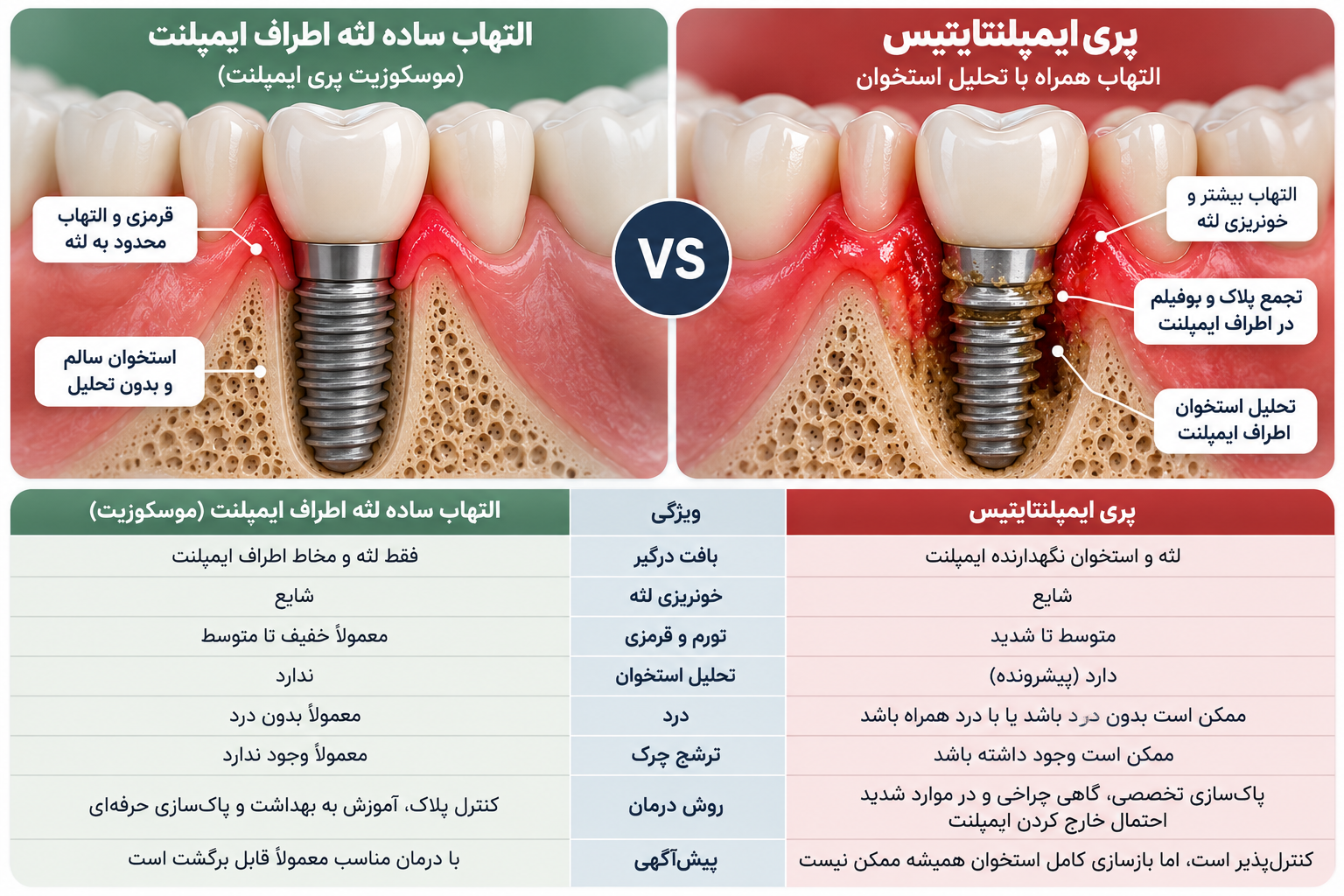 تفاوت پری ایمپلنتایتیس با التهاب ساده لثه اطراف ایمپلنت