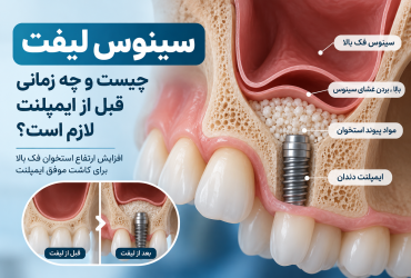 سینوس لیفت چیست و چه زمانی قبل از ایمپلنت لازم است