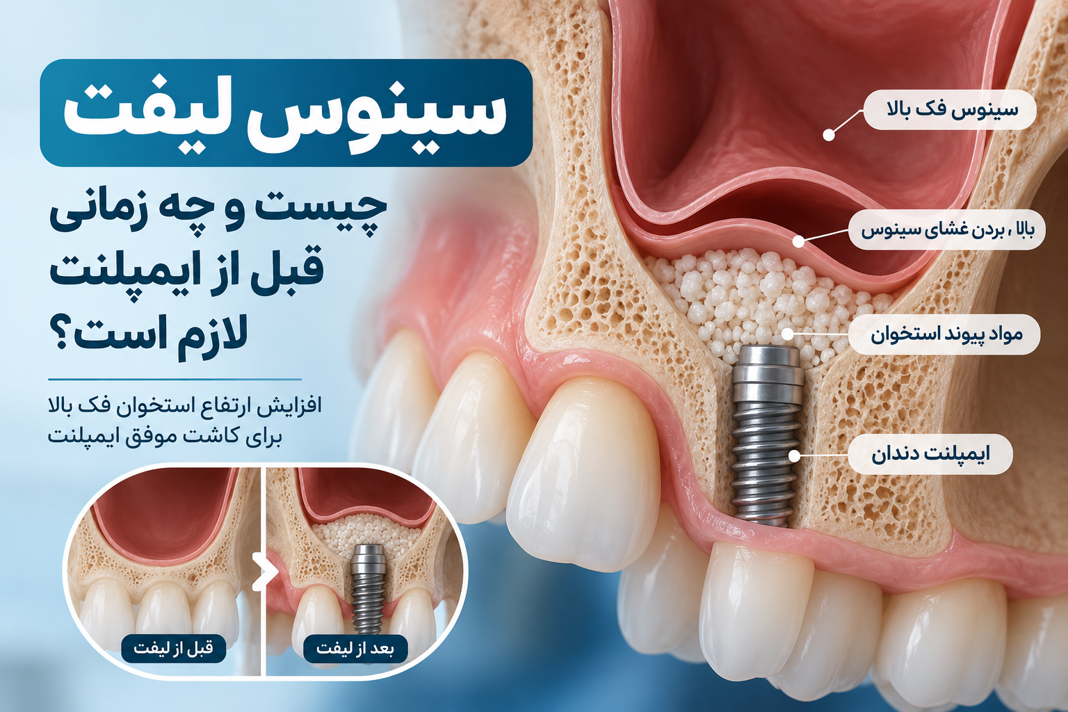 سینوس لیفت چیست و چه زمانی قبل از ایمپلنت لازم است