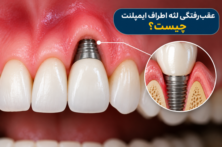 عقب‌ رفتگی لثه اطراف ایمپلنت چیست