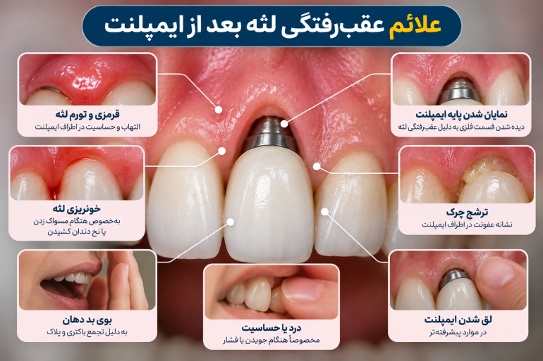 علائم عقب‌رفتگی لثه بعد از ایمپلنت