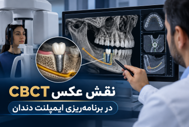 نقش عکس CBCT در برنامه‌ریزی ایمپلنت دندان