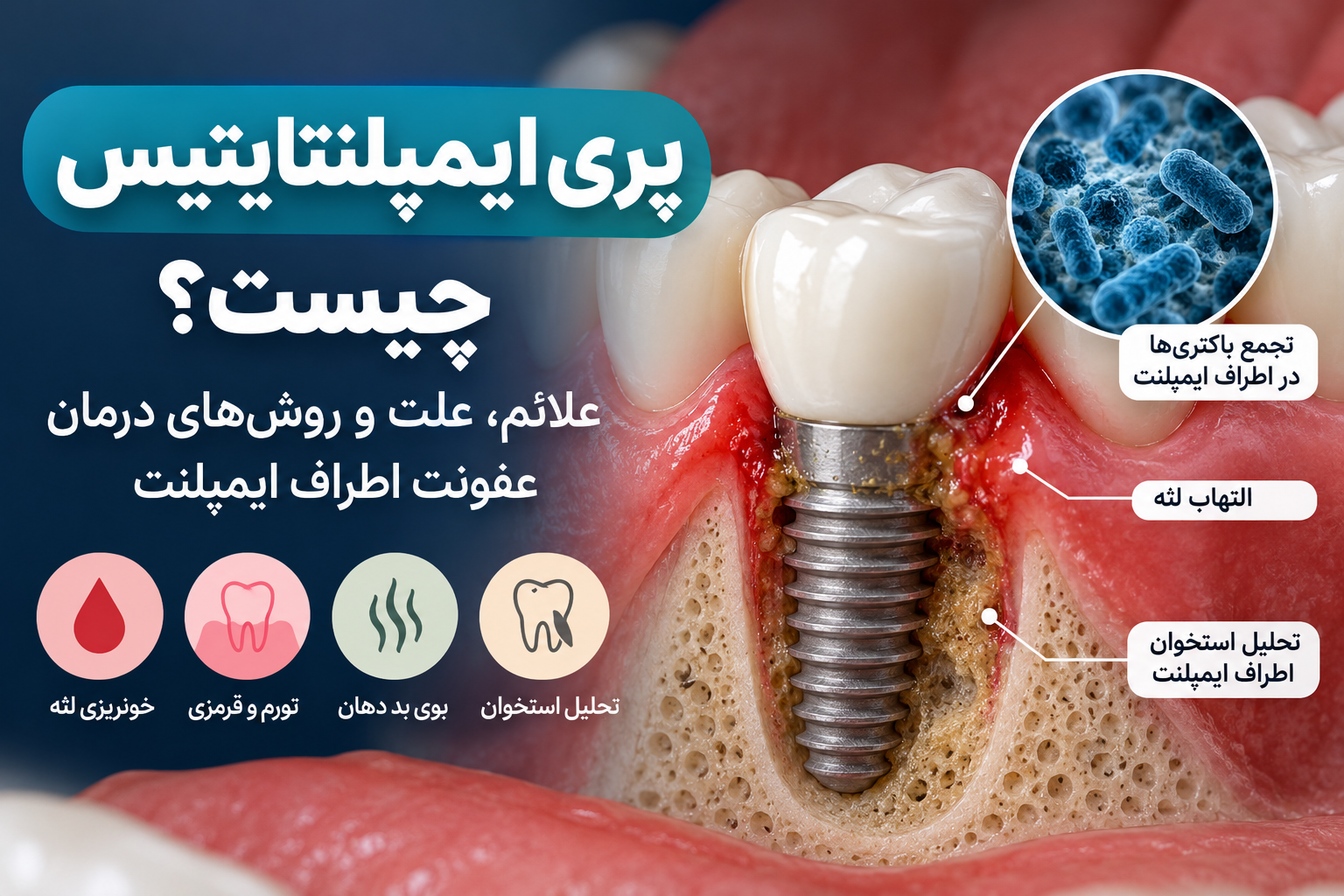 پری‌ایمپلنتایتیس چیست